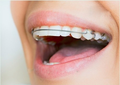 Niềng răng hô mất thời gian bao lâu là có kết quả? 3