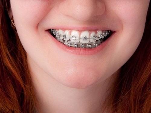 Niềng răng thẩm mỹ có tốt không? Nên áp dụng với trường hợp nào 1