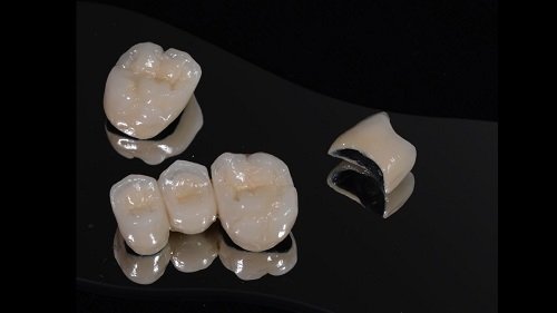 Nguyên nhân và cách khắc phục bọc răng sứ bị thâm lợi 1