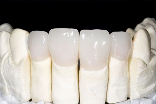 Bọc răng sứ có ảnh hưởng gì không? Tham khảo tại nha khoa 1