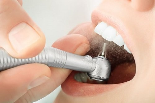 Bọc răng sứ có ảnh hưởng gì không? Tham khảo tại nha khoa 3