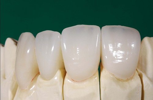 Bọc răng sứ giữ được bao lâu? Phụ thuộc những yếu tố nào? 1