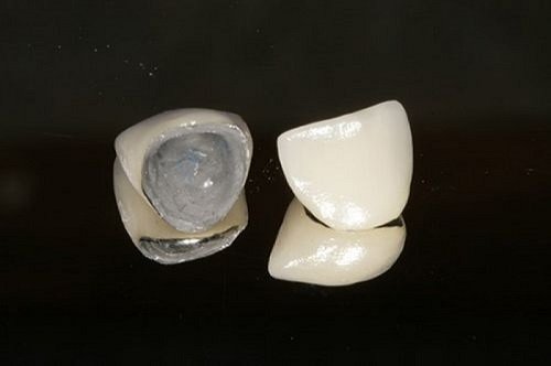 Ưu và nhược điểm bọc răng sứ kim loại thường bạn nên biết 1