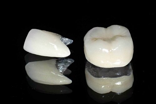 Bọc răng sứ titan có tốt không? Lý giải từ nha khoa 1