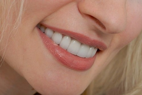 Bọc răng sứ titan có tốt không? Lý giải từ nha khoa 2