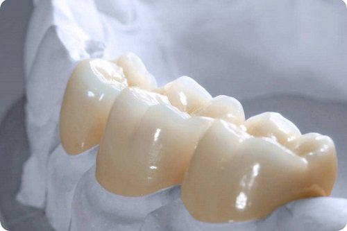 Có nên bọc răng sứ titan? Tìm hiểu về răng sứ titan 1