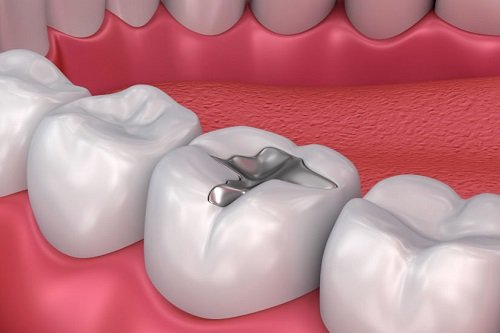 Trám răng có đau không? Lý giải từ nha khoa 3