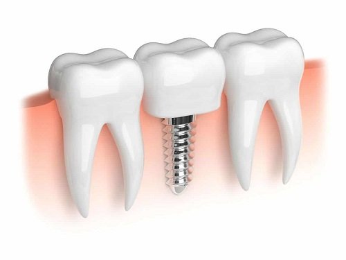 Trồng răng cấm hết bao nhiêu tiền? Bảng giá mới nhất 2