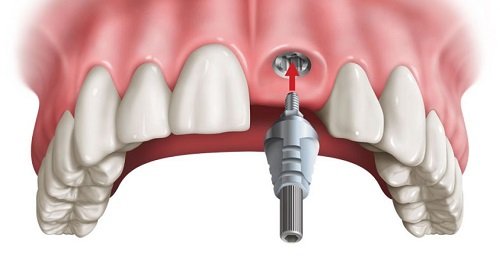 Trồng răng cửa hàm trên với kỹ thuật implant 2