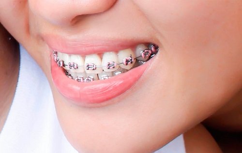 Niềng răng bị hỏng phải khắc phục ra sao? 2