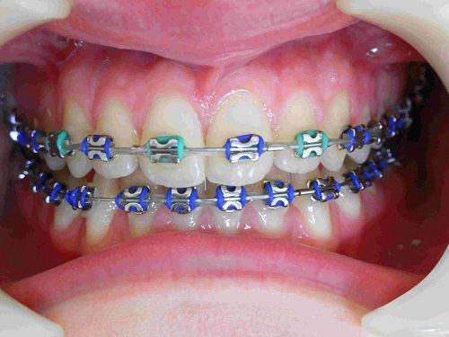 Niềng răng bị lòi chân răng- Cách khắc phục triệt để 1