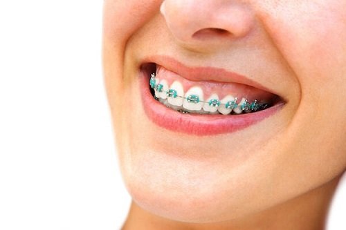 Niềng răng chữa cười hở lợi giải pháp tốt cho bạn 3