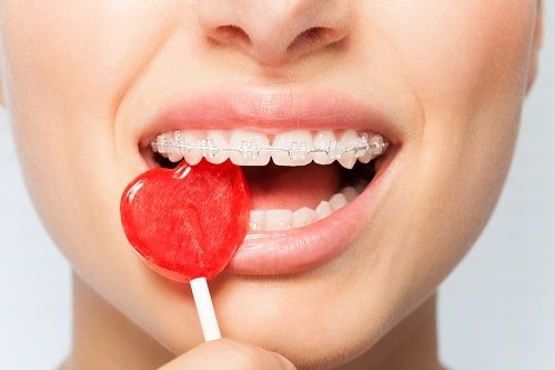 Niềng răng giai đoạn nào đau nhất? Lưu ý khi niềng răng 2
