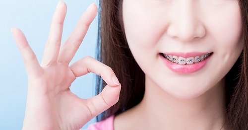 Niềng răng giai đoạn nào đau nhất? Lưu ý khi niềng răng 3