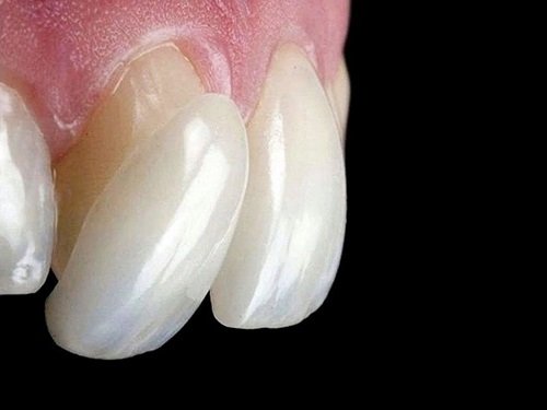 Dấu hiệu răng sứ bị hở - Cách xử lý hiệu quả an toàn 1