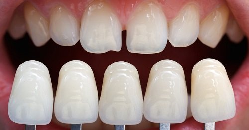 Dấu hiệu răng sứ bị hở - Cách xử lý hiệu quả an toàn 2