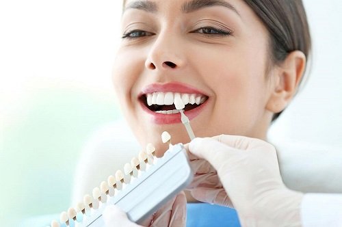 Dấu hiệu răng sứ bị hở - Cách xử lý hiệu quả an toàn 3