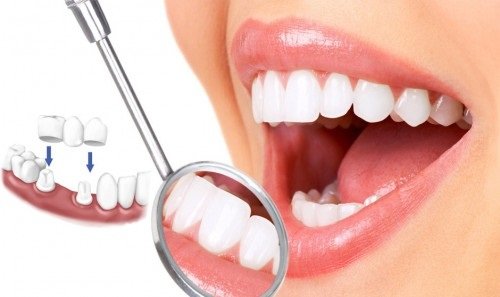 Trồng răng sứ có bền không? Tìm hiểu thông tin 1