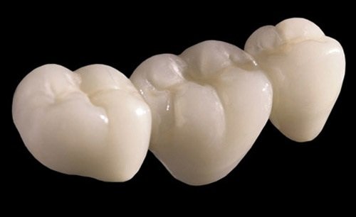 Trồng răng sứ có bền không? Tìm hiểu thông tin 2
