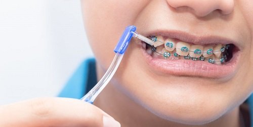 Niềng răng dùng bàn chải gì giúp vệ sinh hiệu quả? 1