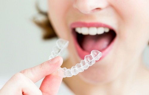 Niềng răng invisalign có nhổ răng không? Nha khoa tư vấn 2