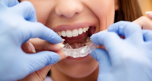 Niềng răng invisalign có nhổ răng không? Nha khoa tư vấn 3