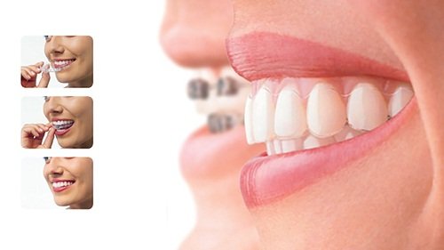Tìm hiểu về niềng răng lệch hàm tại nha khoa 2
