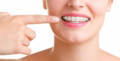 Cách xử lý khi niềng răng lệch nhân trung 1