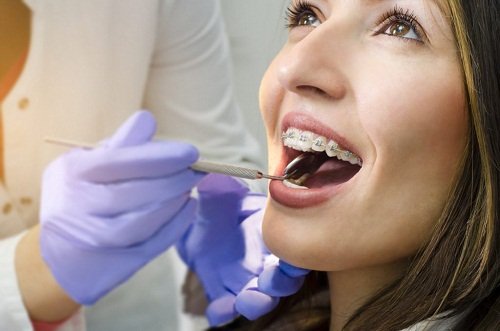 Niềng răng xong bị hở lợi phải khắc phục ra sao? 1