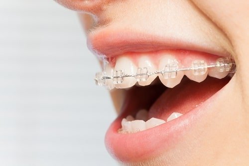 Niềng răng xong bị hở lợi phải khắc phục ra sao? 2