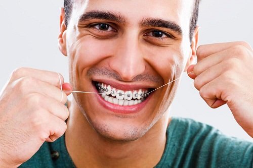 Niềng răng xong bị hở lợi phải khắc phục ra sao? 3