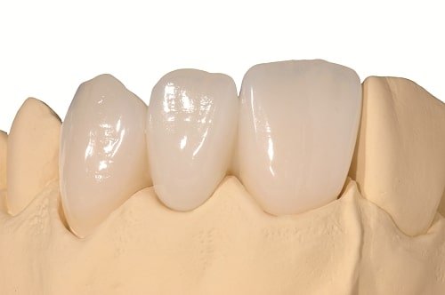 Răng sứ bị mòn phải khắc phục ra sao? 2