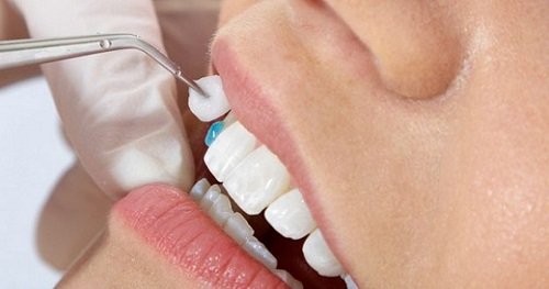 Trồng răng sứ có ảnh hưởng gì không? Tìm hiểu ngay 1
