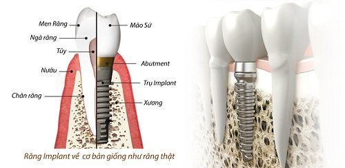 Trồng răng sứ có lâu không? Quy trình thực hiện 1