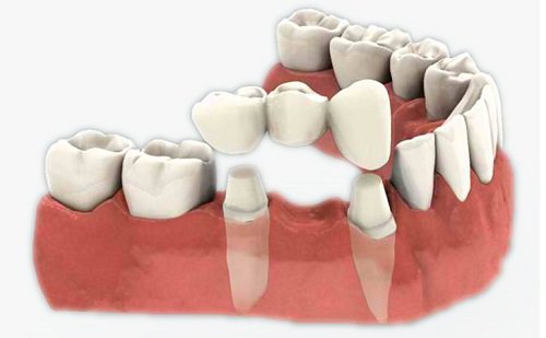 Trồng răng sứ có tốt không? Tìm hiểu từ nha khoa 1