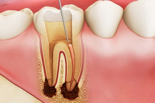 Trám răng lấy tủy giá bao nhiêu tiền tại nha khoa? 1