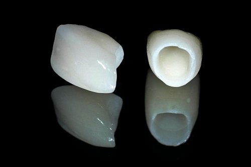 Trồng răng sứ không kim loại có nên không? Lý do 1