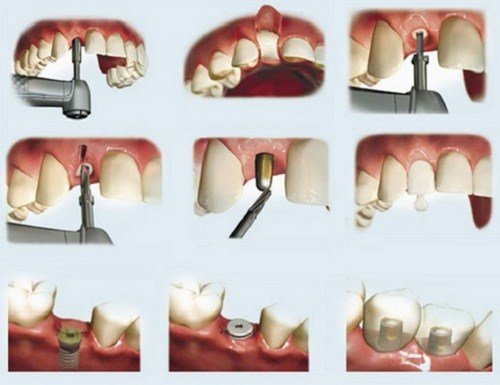 Trồng răng có chân răng - Tìm hiểu quy trình thực hiện 2