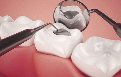 Trám răng có phải lấy tủy không? Áp dụng với trường hợp nào? 1