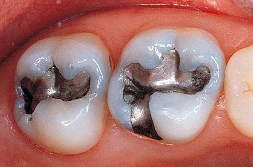 Trám răng có phải lấy tủy không? Áp dụng với trường hợp nào? 3
