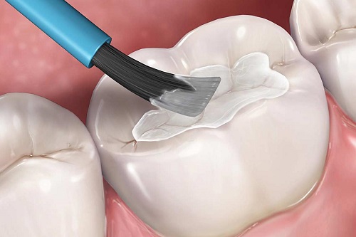 Trám răng thẩm mỹ có bền không? Cách tăng tuổi thọ cho răng 1