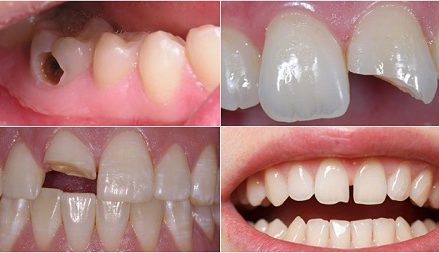 Trám răng thẩm mỹ có bền không? Cách tăng tuổi thọ cho răng 2
