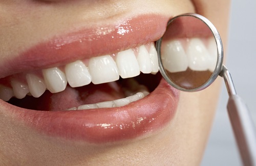 Trám răng thẩm mỹ có bền không? Cách tăng tuổi thọ cho răng 3