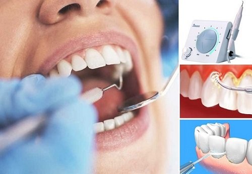 Cạo vôi răng siêu âm an toàn hiệu quả 3