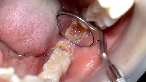 Trám răng lấy tủy có đau không? Chia sẻ từ nha khoa 2