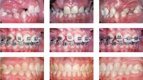 Niềng răng hàm dưới mất bao lâu là hoàn thành? 1