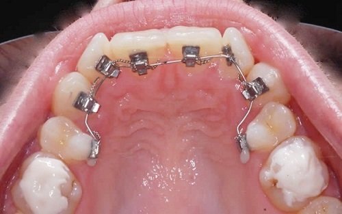 Niềng răng hàm dưới mất bao lâu là hoàn thành? 2