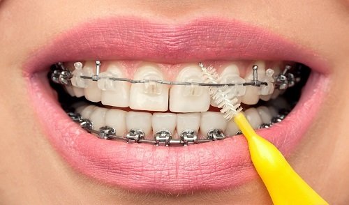 Niềng răng hàm dưới mất bao lâu là hoàn thành? 4