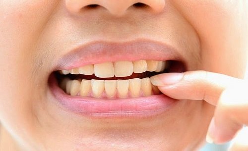 Có nên tẩy trắng răng nhiều lần không bác sĩ? 2