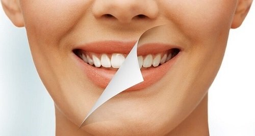 Có nên tẩy trắng răng nhiều lần không bác sĩ? 3